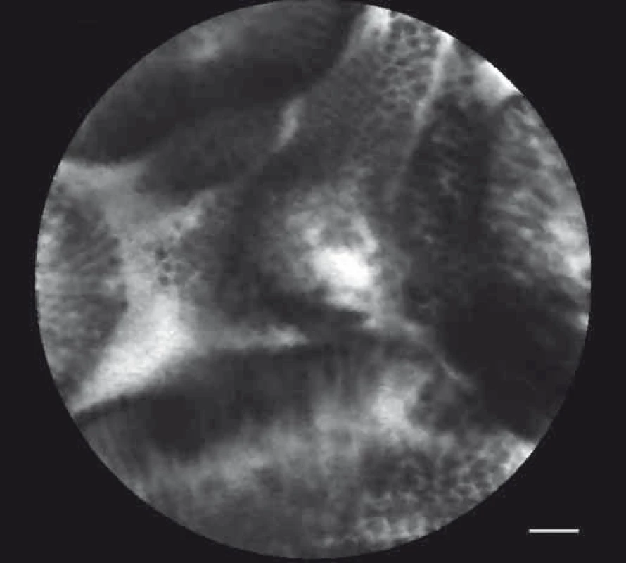 pCLE obraz – intraduktální papilární mucinózní neoplazie.