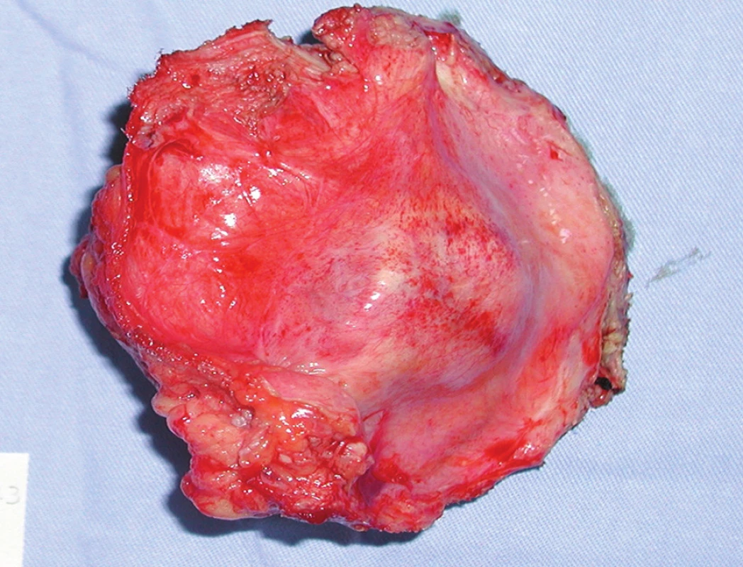 Exstirpovaná metastáza adenokarcinómu do brušnej steny
Fig. 2. Exstirpated metastasis of adenocarcinoma into abdominal wall