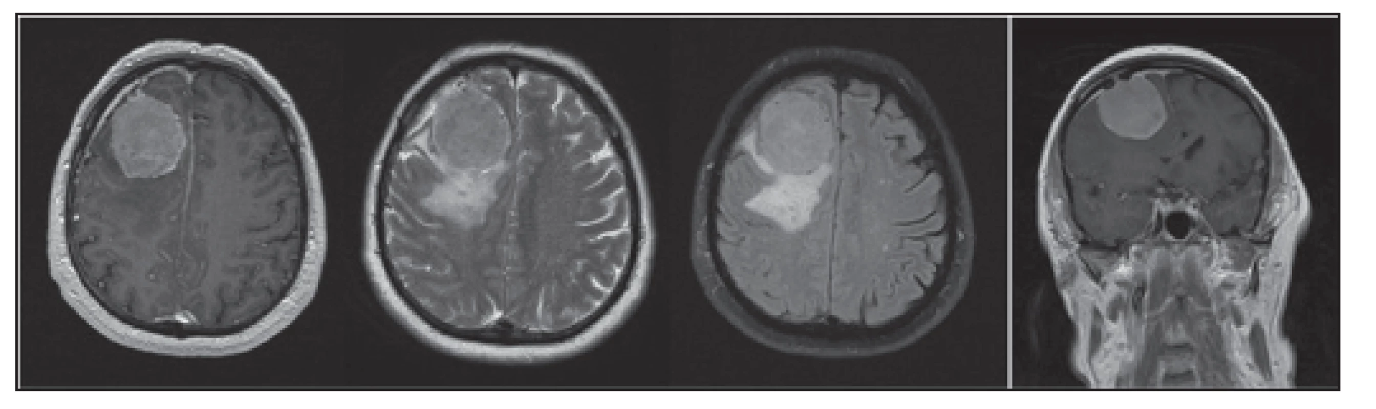 MRI mozku s nálezem extraaxiálního tumoru - meningeomu lokalizovaného frontálně vpravo o průměru 40 mm s perifokálním edémem a incipietní subfalcijní herniací doleva.