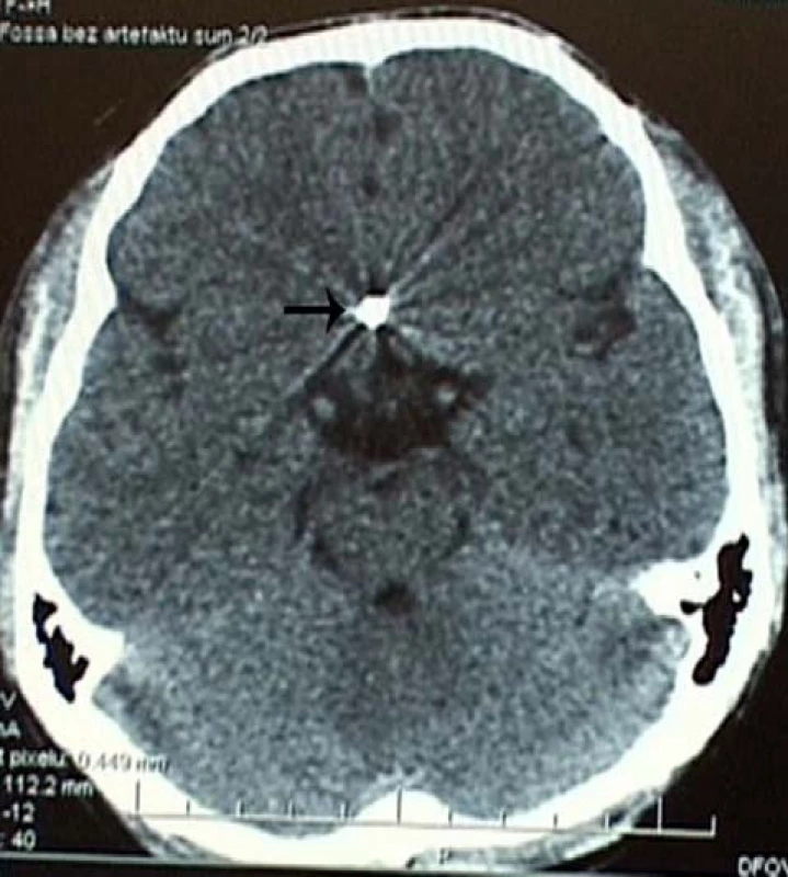 Nativní CT mozku. Šipka ukazuje na špičku hřebu, mířící do oblasti přední části Willisova okruhu.