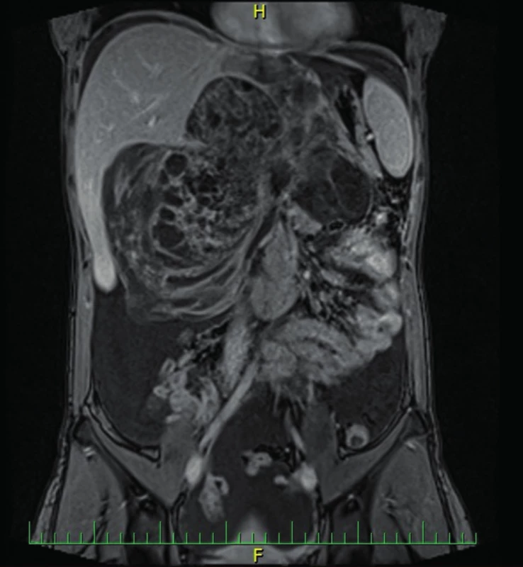 MR břicha 16. 5. 2014
Fig. 1: Abdominal MRI 16. 5. 2014