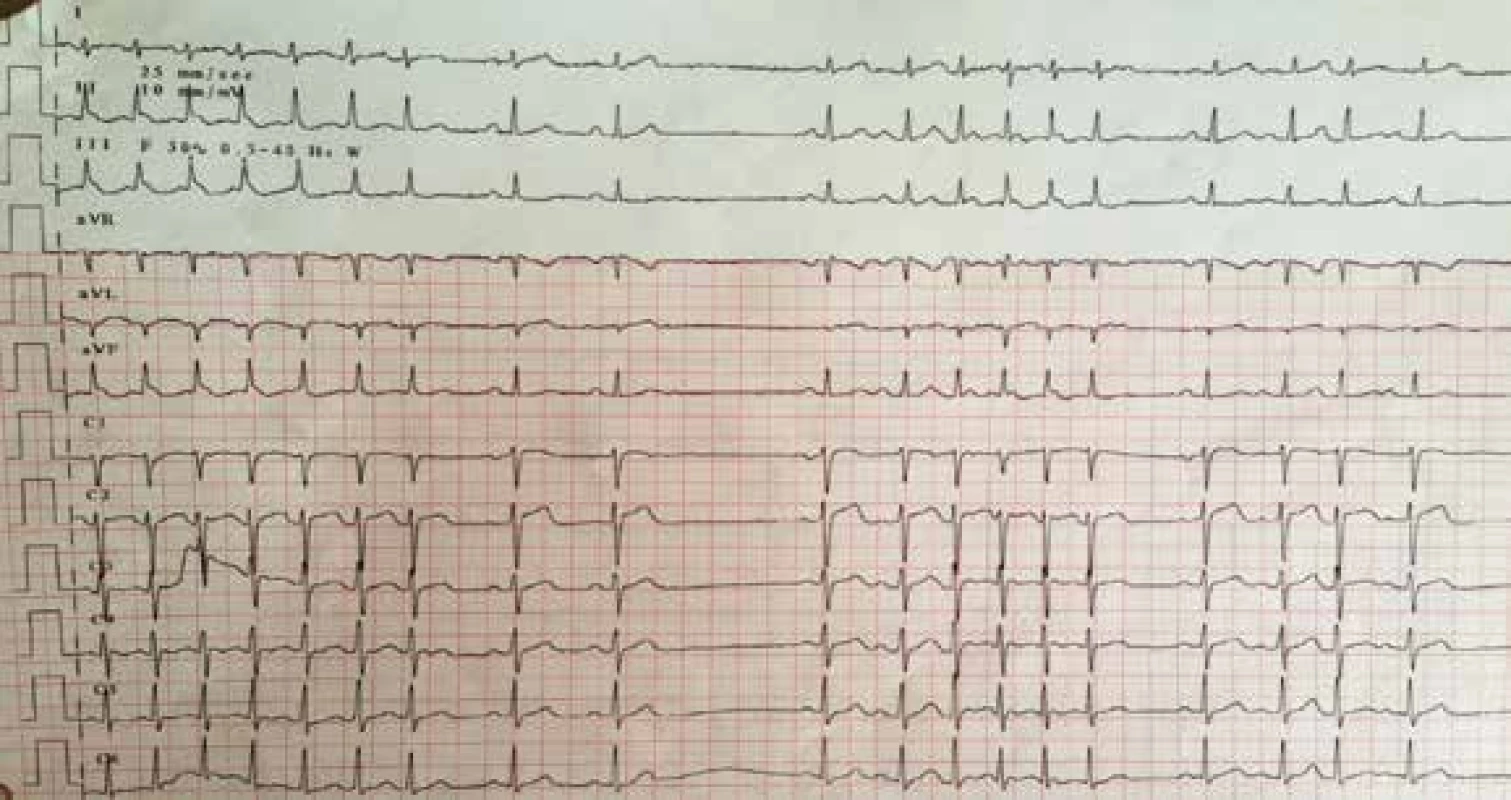 Vstupní EKG s SVT s rychlou komorovou odezvou