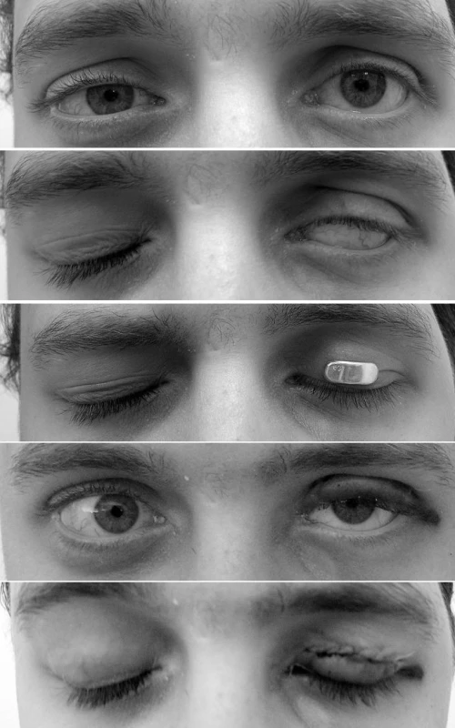 1. Levostranná retrakce horního víčka u obrny n VII
2. Lagoftalmus při snaze uzavřít oční štěrbinu (House- Brackmann skóre V)
3. Redukce lagoftalmu zlatým implantátem
4. První pooperační den s implantátem v horním víčku
5. Pacient poprvé uzavírá oční štěrbinu