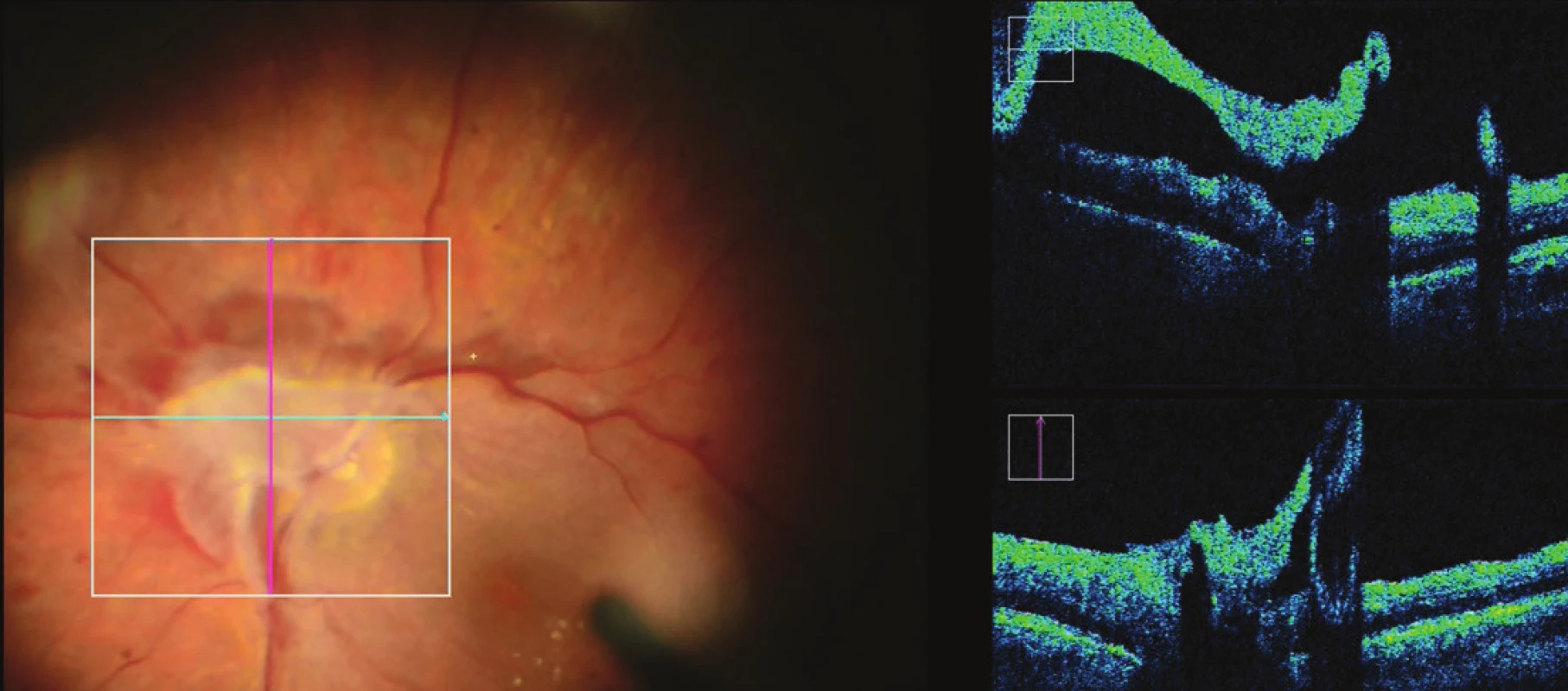 iOCT upřesňuje anatomické uspořádání proliferace při terči zrakového nervu
