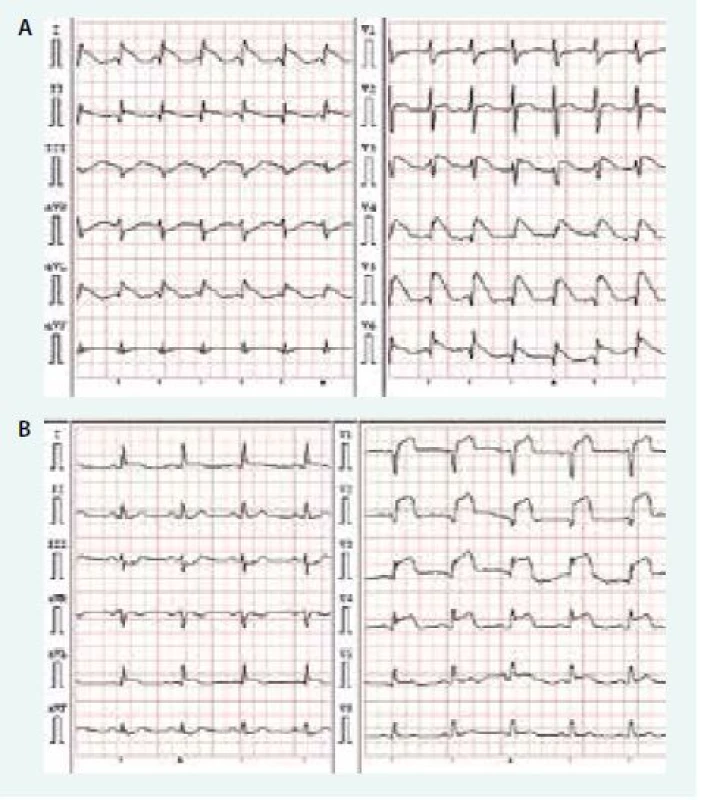 Srovnání EKG pacienta s TCM (A) a EKG pacienta s akutním infarktem myokardu s elevacemi úseku ST v oblasti přední stěny (B).