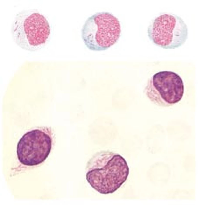 Historická vyobrazení myeloblastů s Auerovými tyčemi.

