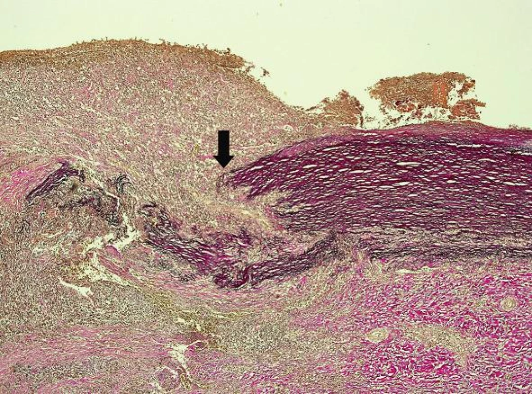 V blízkosti perforácie aorty bolo izolované ložisko segmentálneho rozpadu elastických vlákien (šípka) (hematoxylín eozín, zväčšenie 40x).