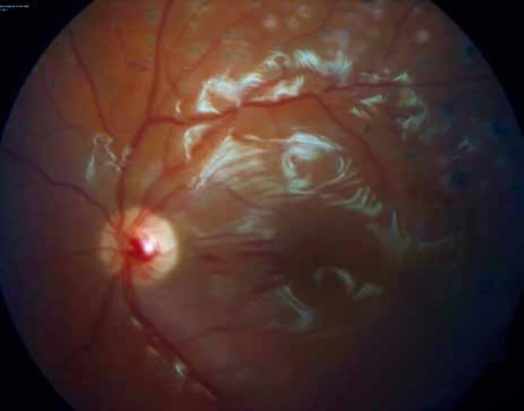 Pacient č. 2: Fundus oka levého: stav po PPV – sítnice je přiložena, odlesky od silikonového oleje, stopy po laserové koagulaci.