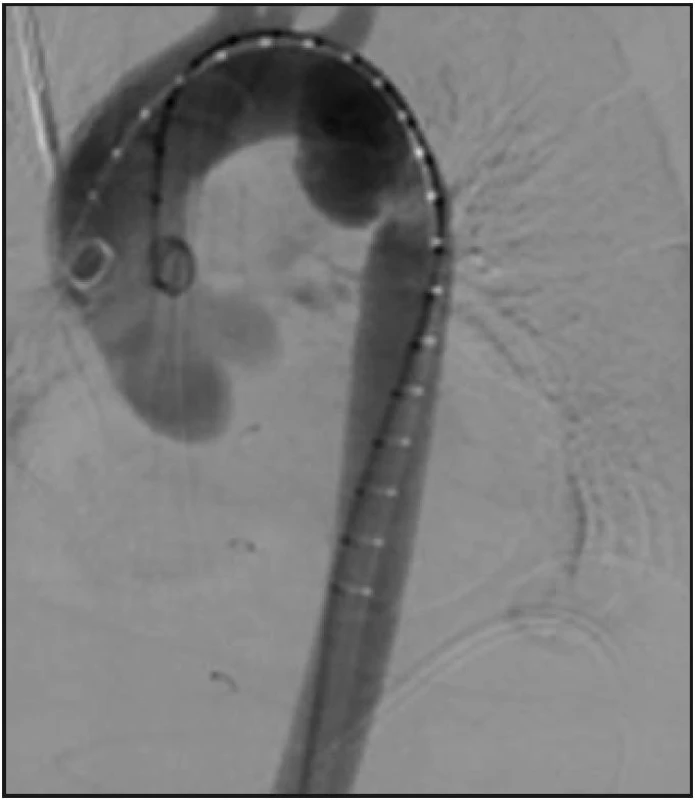 Intervenční angiografie aorty - stentáž traumatické disekce hrudní aorty