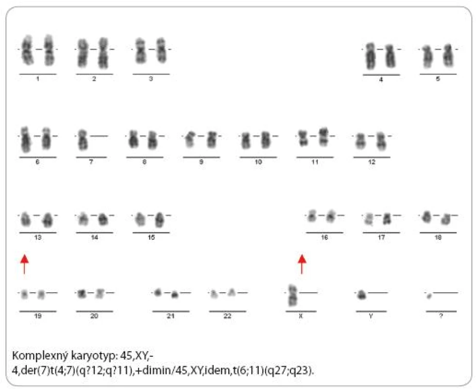 Komplexný karyotyp s translokáciou MLL/AF6.