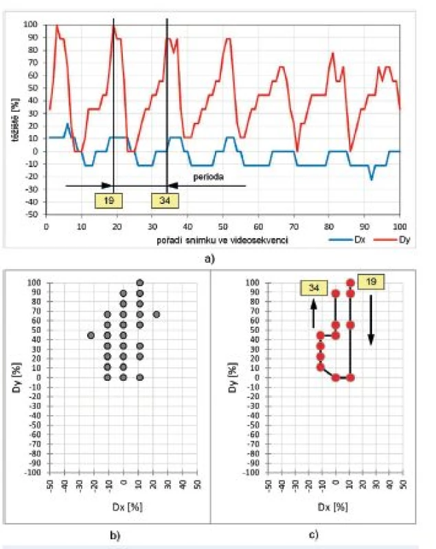 Vývoj parametrů Dx a Dy těžiště hlasivkové štěrbiny pro diagnózu karcinom vlevo- (muž,  SPL = 81 dB, F<sub>o</sub> = 298 Hz):