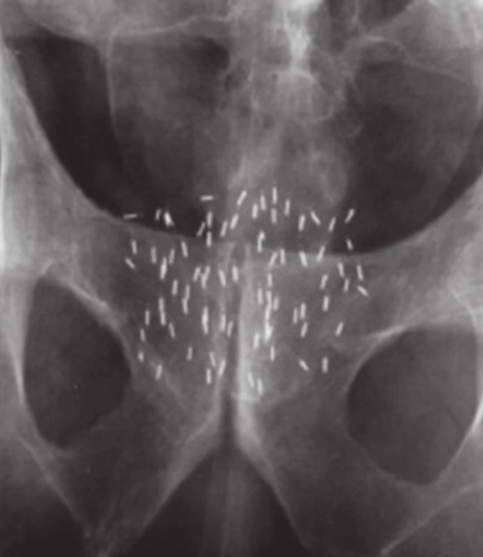 Permanentní brachyterapie, jodová zrna v prostatě 
Fig. 7. Permanent brachytherapy, iodine seeds in the prostate
