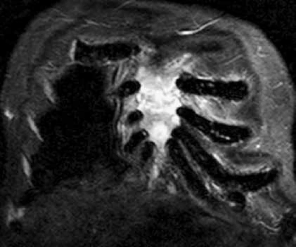 Současné CT a MR vyšetření hrudníku u pacienta s bolestmi hrudního koše a monoklonální gamapatií.
Standardní RTG zobrazení skeletu u tohoto pacienta neprokazovalo vůbec žádné známky mnohočetného myelomu, zatímco na MR a CT je již zřetelný obraz pokročilé nemoci, vyžadující léčbu. Tyto snímky ilustrují, že v případně bolesti páteře a kostí u člověka s monoklonální gamapatií je nutno při negativním nálezu na klasickém RTG provést další doplňující vyšetření.