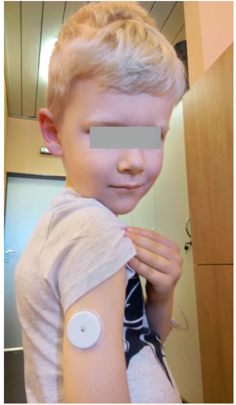 Senzor pro kontinuální monitorování glykémie
FreeStyle Libre (Abbott) zavedený osmiletému
chlapci s diabetem 1. typu.