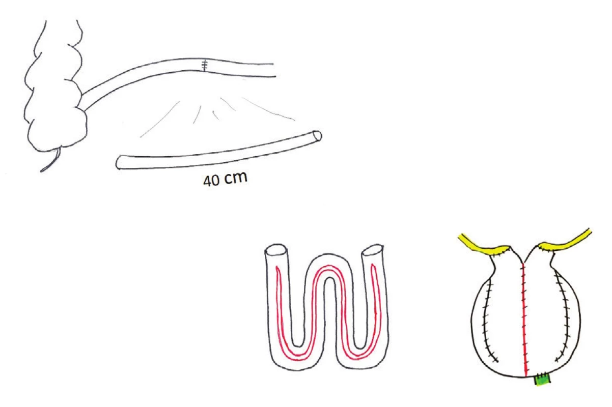 W-pouch, ileální ortotopická náhrada močového měchýře – schéma: exkludace 40 cm preterminálního ilea; detubularizace s ponecháním tubulárních segmentů na koncích délky 2−3 cm; konstrukce sférického pouche napojeného na pahýl uretry; přímá implantace ureterů do otevřených konců ilea
Fig. 4: W-orthotopic neobladder – diagram: 40 cm of excluded preterminal ileum, with two 2−3 cm chimneys at the ends, to which ureters are directly implanted