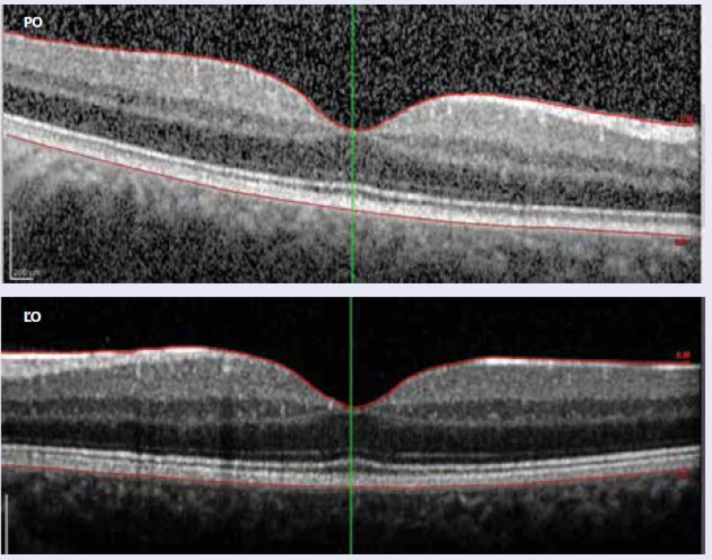 OCT 26. 2. 2016: pravé oko (PO) stále nález fyziologický, ľavé oko (ĽO) – fokálny edém makuly je už vstrebaný, foveálna depresia v norme