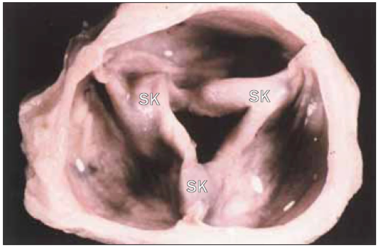 Revmatická aortální stenóza u pacienta s koexistující mitrální regurgitací. Otvor aortální chlopně je vlivem fúze všech 3 komisur trojúhelníkový.