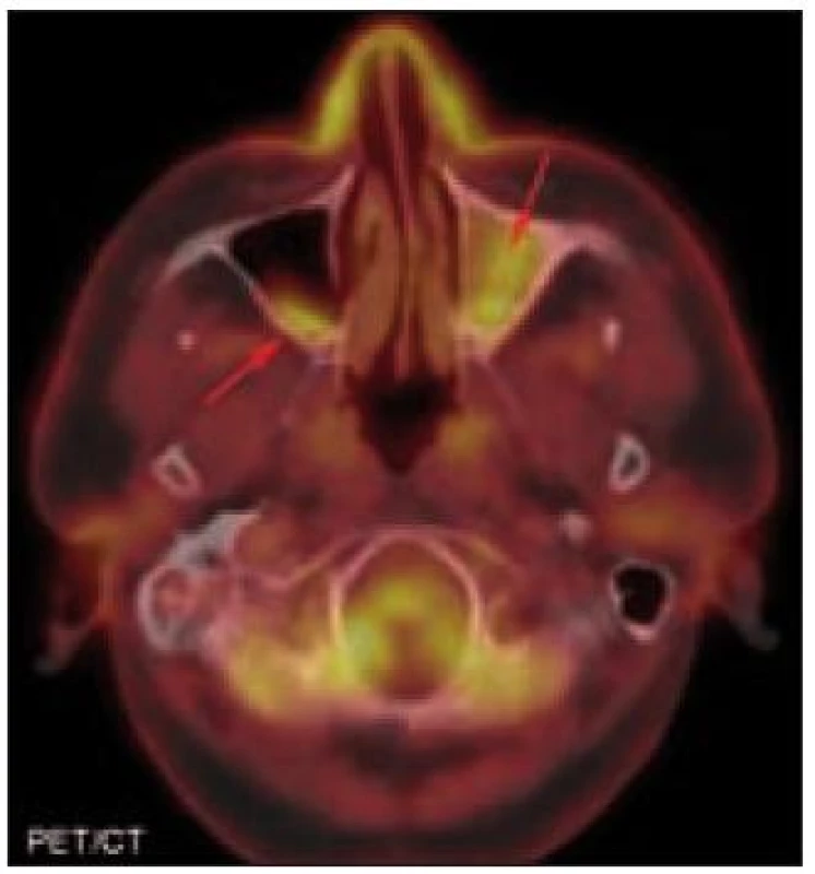 PET/CT hlavy. Nevýrazný měkkotkáňový lem na zadní stěně pravého maxilárního sinu. Měkkotkáňové struktury v levém maxilárním sinu, maximum změn laterálně a bazálně. PET komponenta zachycuje difuzně zvýšenou aktivitu FDG v místech strukturálních změn popisovaných na CT. K verifikaci nálezu v levém antru podstoupil pacient supraturbinální antrostomii, při níž byla popsána dutina vyplněná tuhou jizevnatou tkání bělavého zbarvení. Po subtotální exenteraci maxilární dutiny byl vzorek tkáně odeslán k histologickému vyšetření. Imunohistochemická analýza prokázala CD68 pozitivní buňky a stav byl následně, i s ohledem na nález sklerotických změn okolního skeletu na PET/CT vyšetření, uzavřen jako infiltrace levé čelistní dutiny při postižení Erdheimovou-Chesterovou chorobou.