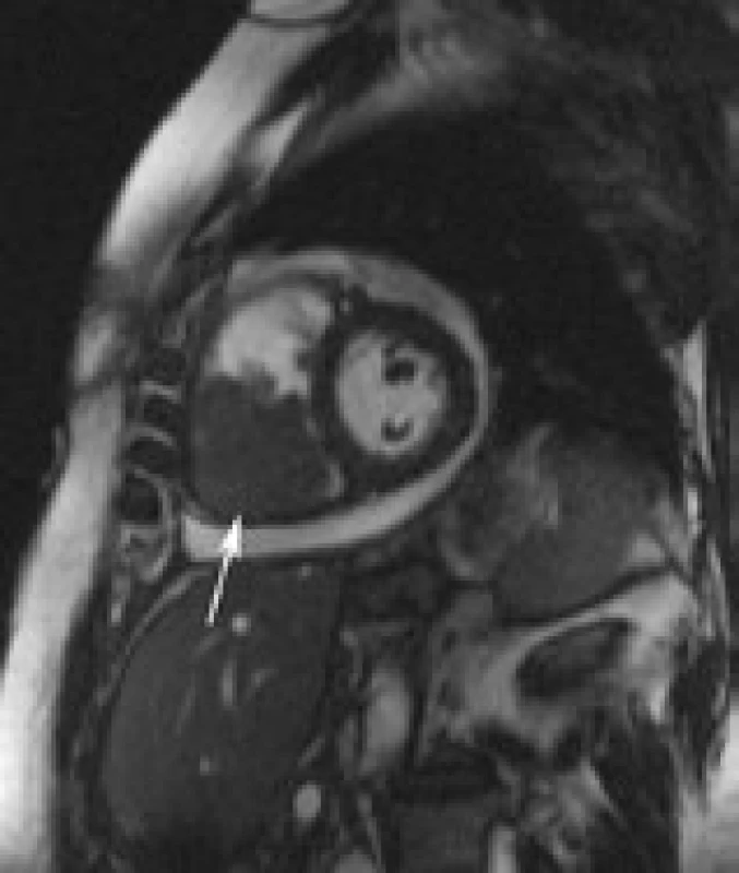 MR zobrazení srdce v krátké ose, v pravé srdeční komoře rozsáhlá tumorózní expanze vyplňující většinu dutiny (hrot šipky), truefisp.