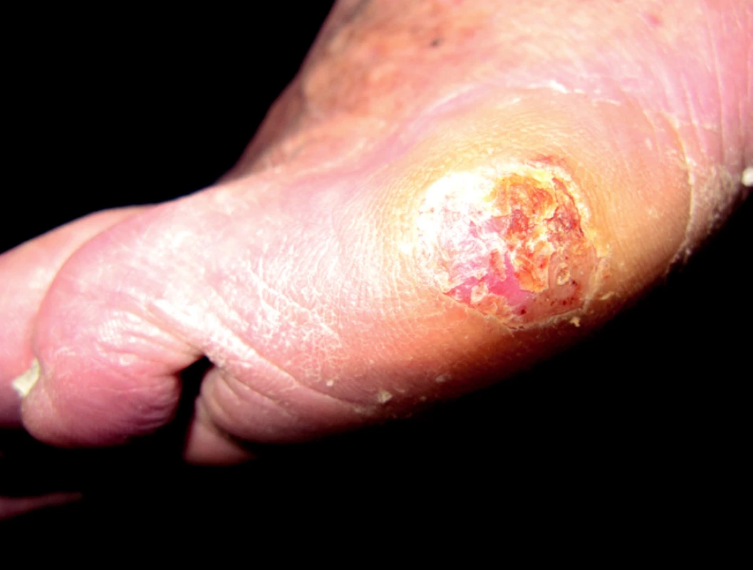 Akrolentiginózní melanom, laterální strana levé nohy.