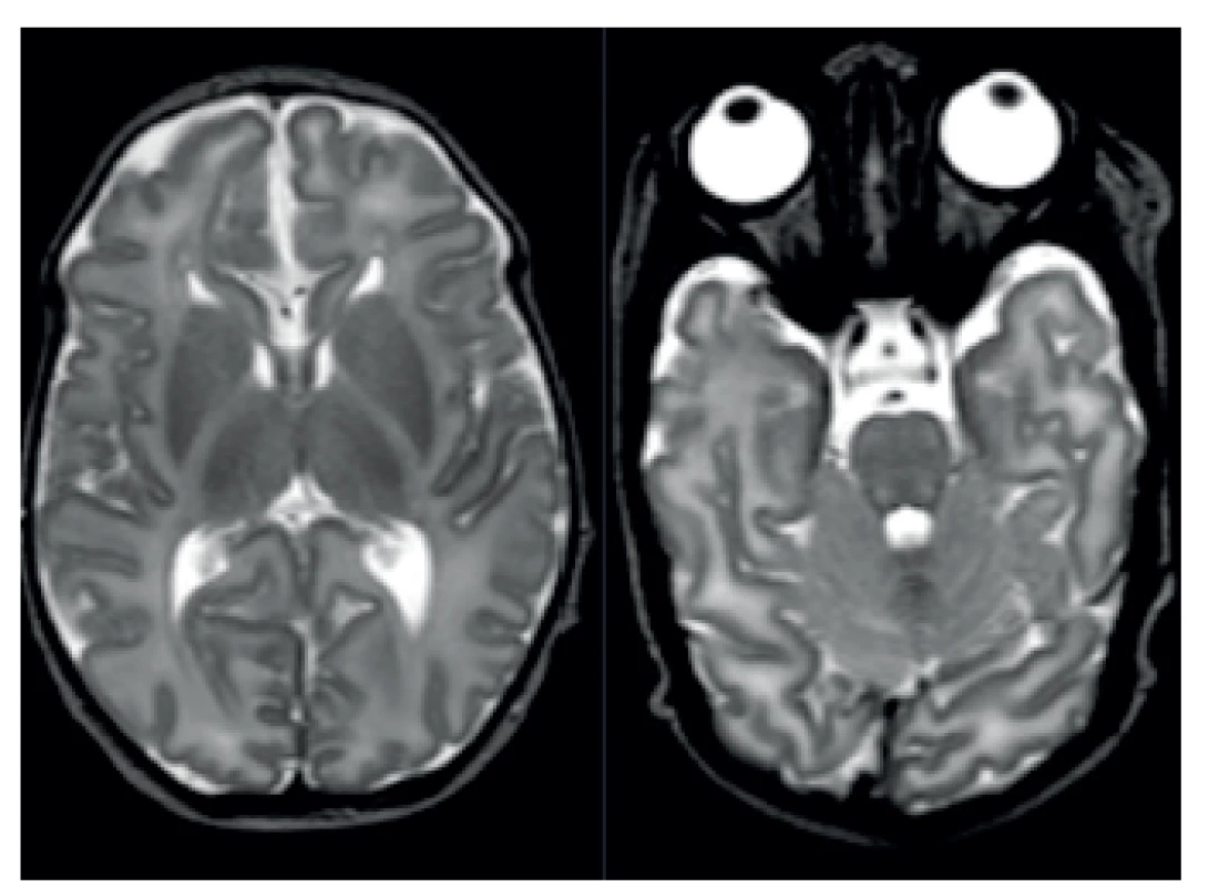 MR patologicky vysoký signál v zadních raménkách capsula interna na T2-vážených obrazech.
Fig. 3. MRI pathologically high signal in posterior bridge capsula interna in T2 high weight scan.