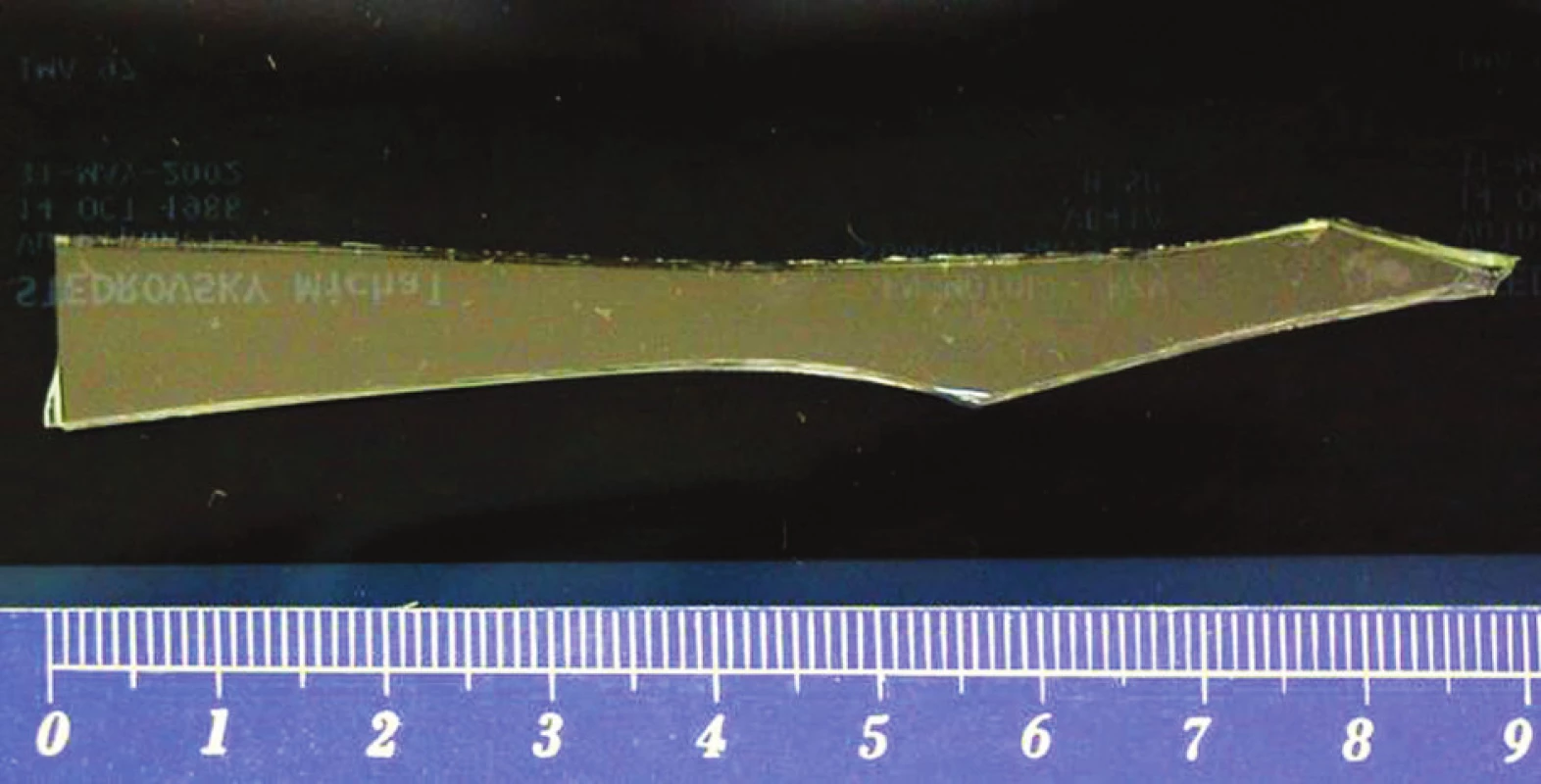 Odstraněný střep z jater velikosti 9 cm
Fig. 3: Removed glass fragment from liver, size of fragment 9cm