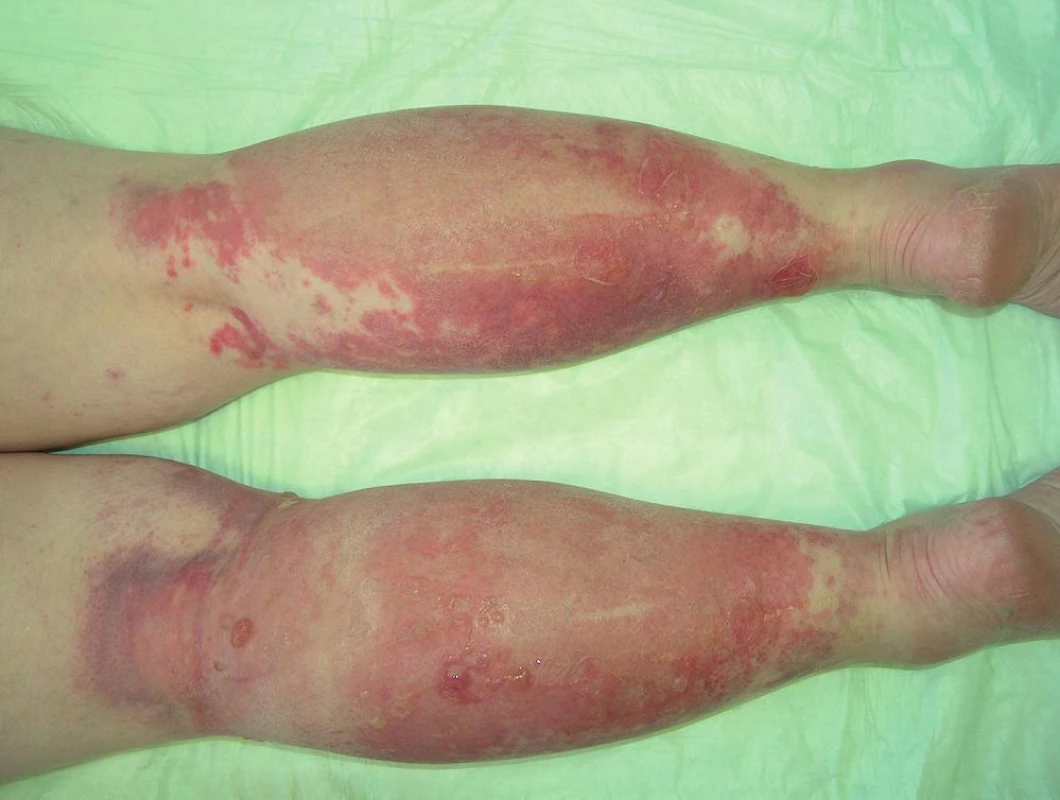 Kontaktní alergická dermatitida na bércích (ketoprofen).