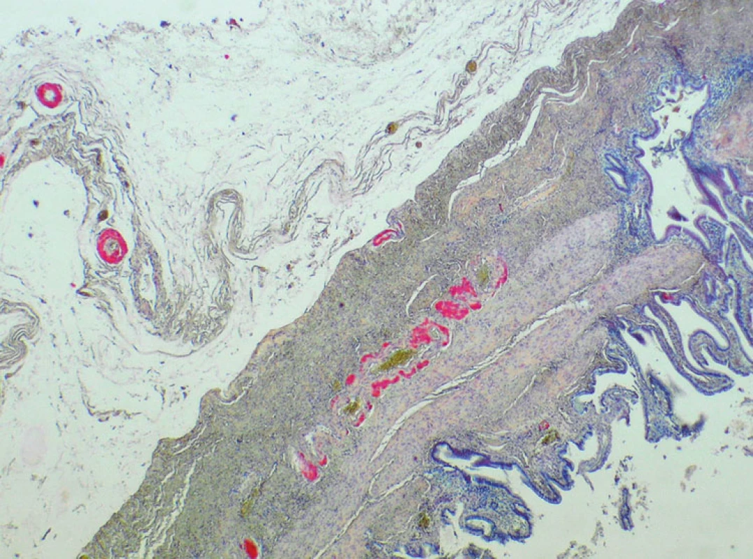 Depozita amyloidu v adventicii cévní stěny (barvení na kongo červeň)
Fig. 1. Amyloid deposits in the vascular wall adventitia (Congo red staining)