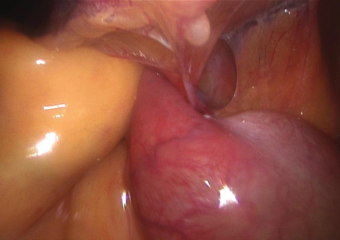 Vnitřní kýla u druhého pacienta
Fig. 7: Internal hernia of the second patient