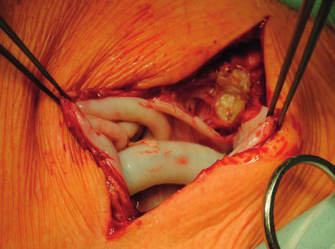 Proximal anastomosis of axillofemoral bypass before its explantation. A white pseudocapsule is present around the graft.
