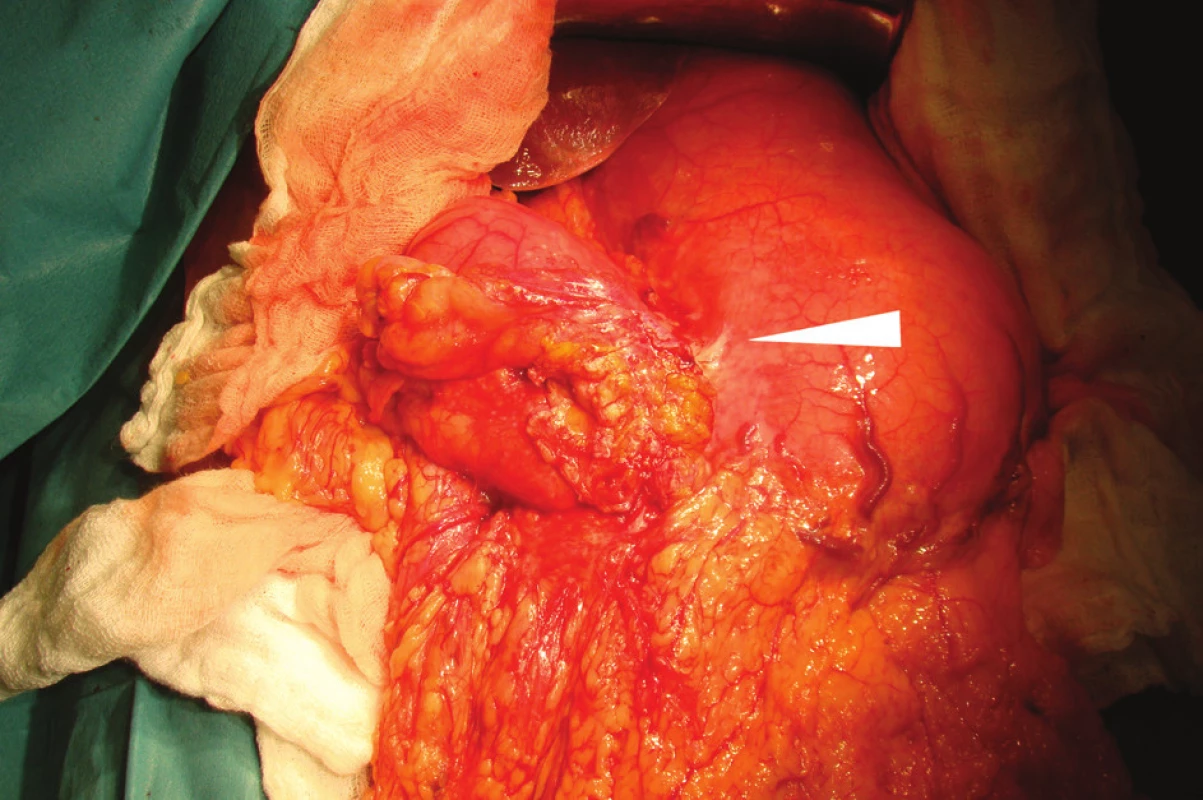 Operační nález: karcinom žaludku na hranici těla a antra při malé kurvatuře (šipka)