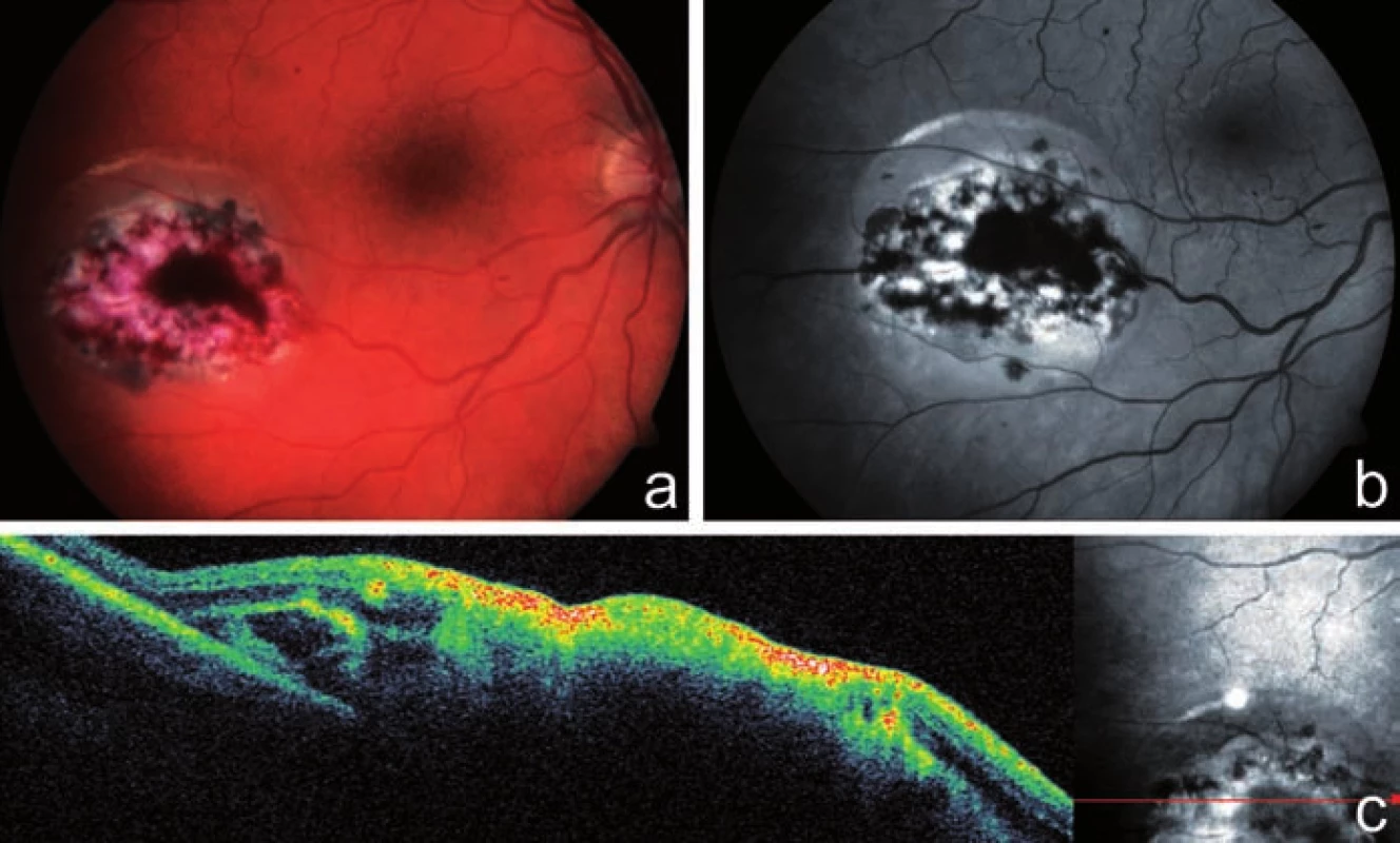 Klinický nález u pacienta z kazuistiky 3. Na fotografii fundu pravého oka u 31letého pacienta po 2 transplantacích kostní dřeně pro akutní myeloidní leukémii je patrné ohraničené bělavé ložisko infiltrované sítnice s hemoragiemi, v bezprostředním okolí ložiska nahoře malá exsudativní amoce sítnice a, b), vertikální scan SD-OCT ložiskem CMV retinitidy dokumentuje destrukci všech vrstev sítnice c)