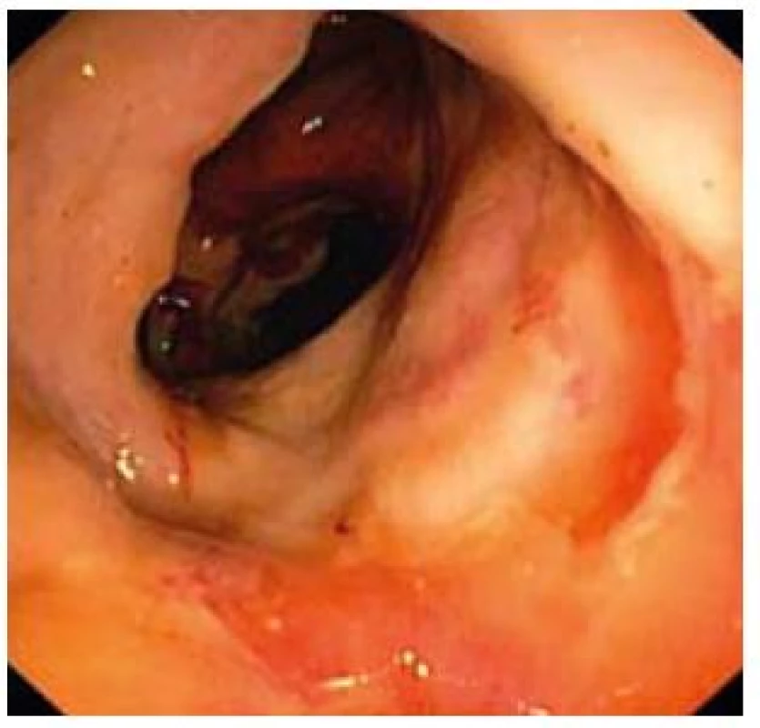 Závažný nález kontinuálnej ulcerácie celej sliznice.
Fig. 7. Serious finding of continuous ulcerations of the entire mucosa.