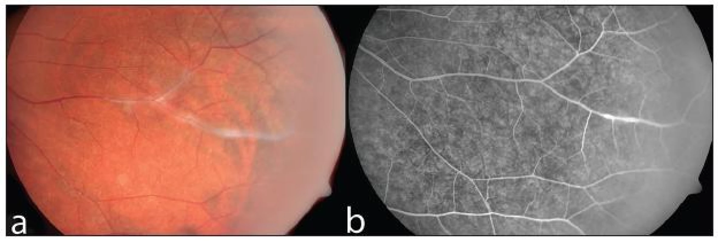 Neaktivní vaskulitida u pacienta s Crohnovou nemocí na barevném snímku očního pozadí (a) a při vyšetření fluorescenční angiografií (b)