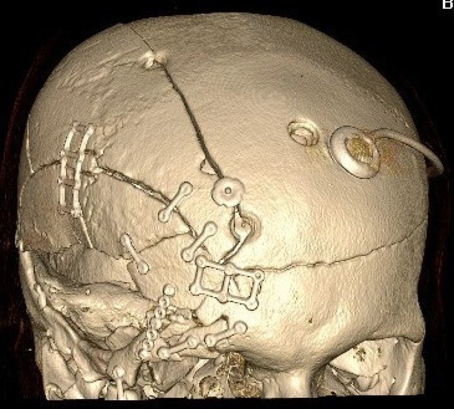 3 D rekonstrukce pooperačních CT snímků téhož pacienta s osteosyntézou kostních fragmentů minidlažkami a zavedeným ventrikuloperitoneálním shuntem