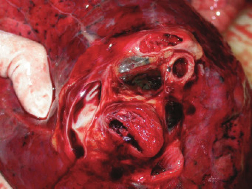 Pohled na mediastinální plochu plíce. V průsvitu lobárních větví plicní arterie jsou tromboemboly zcela vyplňující lumen.