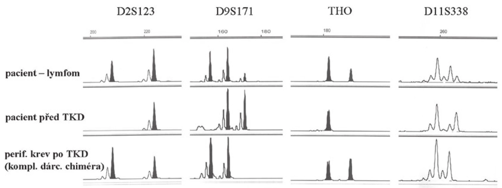 Pacient 8. Fragmentační analýza: srovnání genotypů pomocí STR markerů (D2S123, D9S171, THO a D11S338) - biopsie žaludku s lymfomem, DNA pacienta před transplantací kostní dřeně (TKD) a DNA z periferní krve po TKD, kde byl detekován kompletní dárcovský chimérizmus. Ve vzorku DNA izolované z lymfomu je detekován dárcovský genotyp.