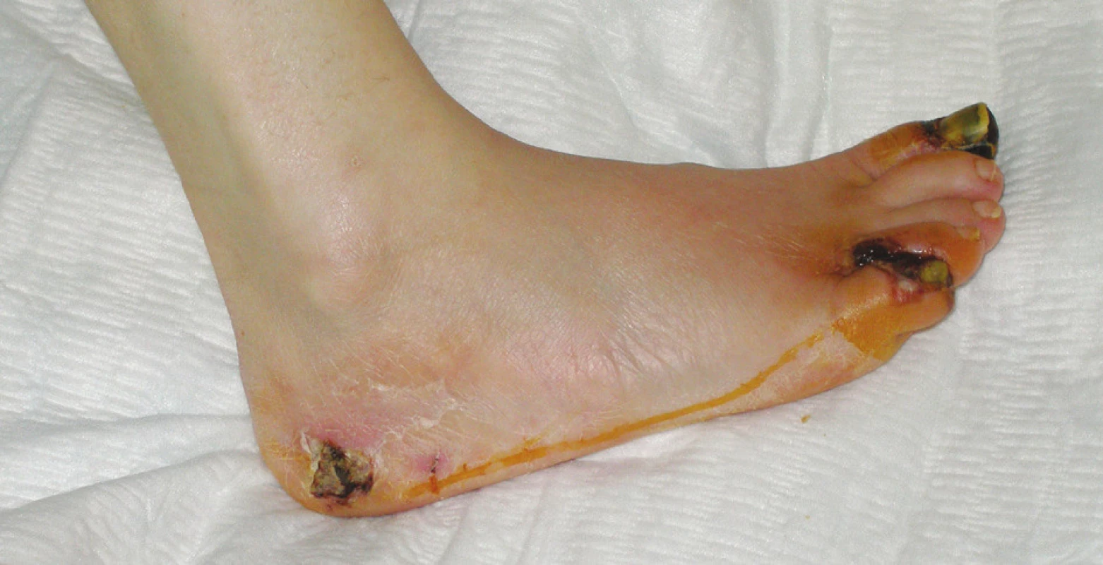 Neuroischemická diabetická noha – suchá gangréna distálneho článku palca, malíčka a medziprstového priestoru medzi 4. a 5. prstom pravej nohy, nekróza v laterálnej oblasti kalkanea (Meggit-Wagner 4. stupeň)
Fig. 1. Neuroischemic diabetic foot – dry gangrene of the distal phalanx of the big toe, the little toe and the 4&lt;sup&gt;th&lt;/sup&gt; interphalangeal space, necrosis in the lateral calcaneal region (Meggit-Wagner grade 4)