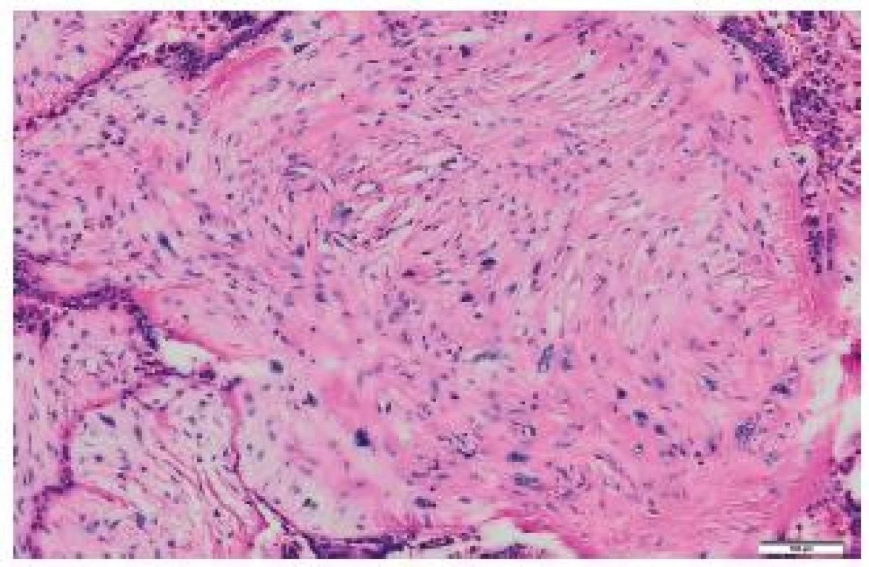 Malignant phyllodes tumor of the breast, HE.