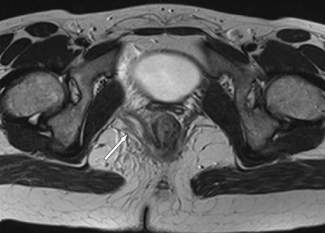 Štěrbinovitý absces v musculus levator ani vpravo
Fig. 4. Fissure abscess in the right musculus levator ani