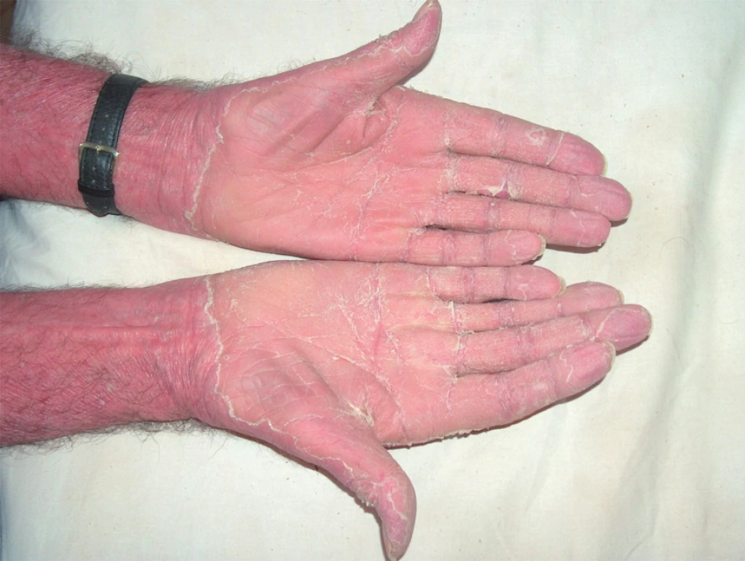 Difuzní, plátovité, oranžové hyperkeratózy dlaní s tvorbou prasklin