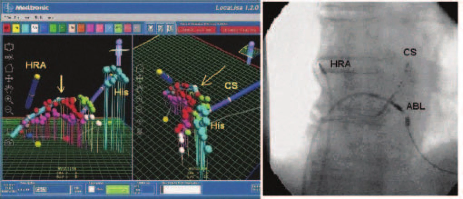 LocaLisa. Panel A: Pohľad na 3 paralelné ablačné línie (červená, fialová, zelená) v oblasti kavotrikuspidálneho istmu – virtuálny model pravej predsiene v AP projekcii (vľavo) a v LAO projekcii (vpravo). Šípky znázorňujú pozíciu ablačného katétra. Panel B: Skiaskopický obraz rovnakého pacienta v AP projekcii.
