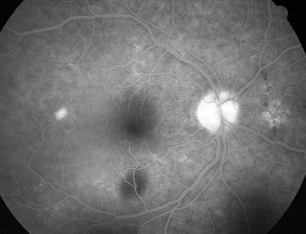 Pac. č. 3: Fluoresceínová angiografia PO: temporálne od okraja makuly sa zvýrazňuje bod presakovania s abláciou okolitého neuroepitelu retiny. Jemné poruchy RPE sú nad a pod makulou