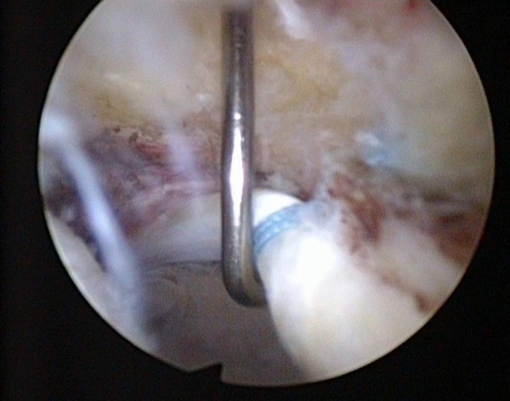 Artroskopie kyčelního kloubu − úprava tvaru hlavice stehenní kosti