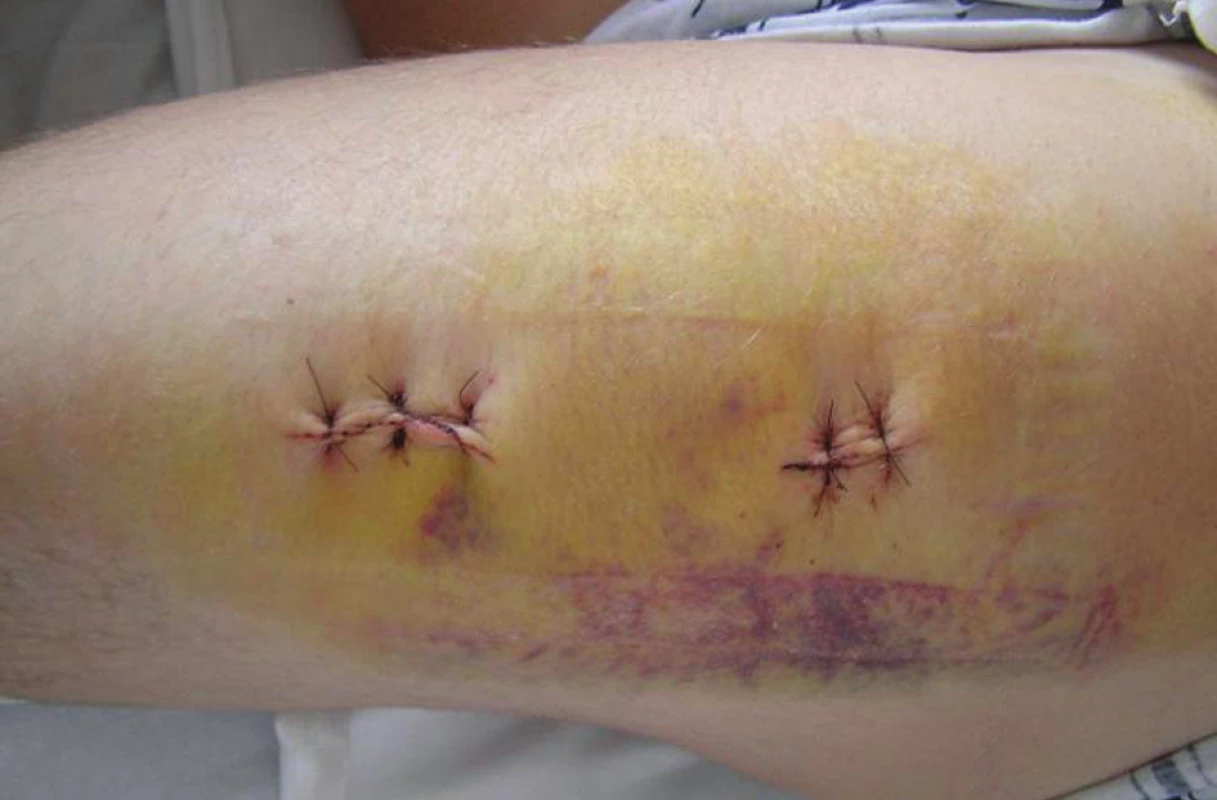 Kožní incize po sutuře rány
Fig. 7. Skin incision following wound suturing