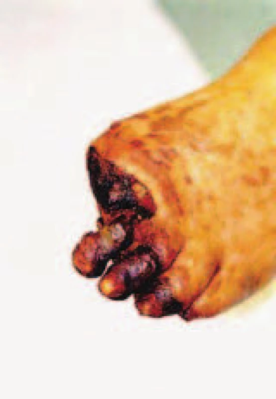 Diabetická noha s gangrénou 3 prstů a amputační plochy po snesení 1. prstu levé nohy.