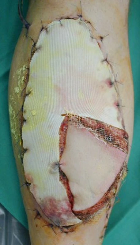 Krytí defektu volným svalovým přenosem laloku m. latissimi dorsi s ostrůvkem kůže k monitoraci prokrvení laloku (část laloku je krytá dočasným syntetickým krytem)