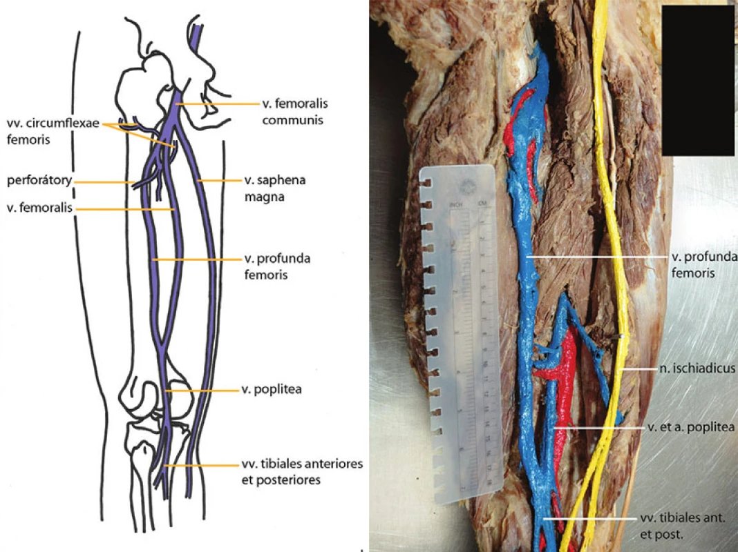 Obr. 2a,b. Regio femoris posterior, fossa poplitea – kolaterální průběh v. profunda femoris (náš pitevní nález)