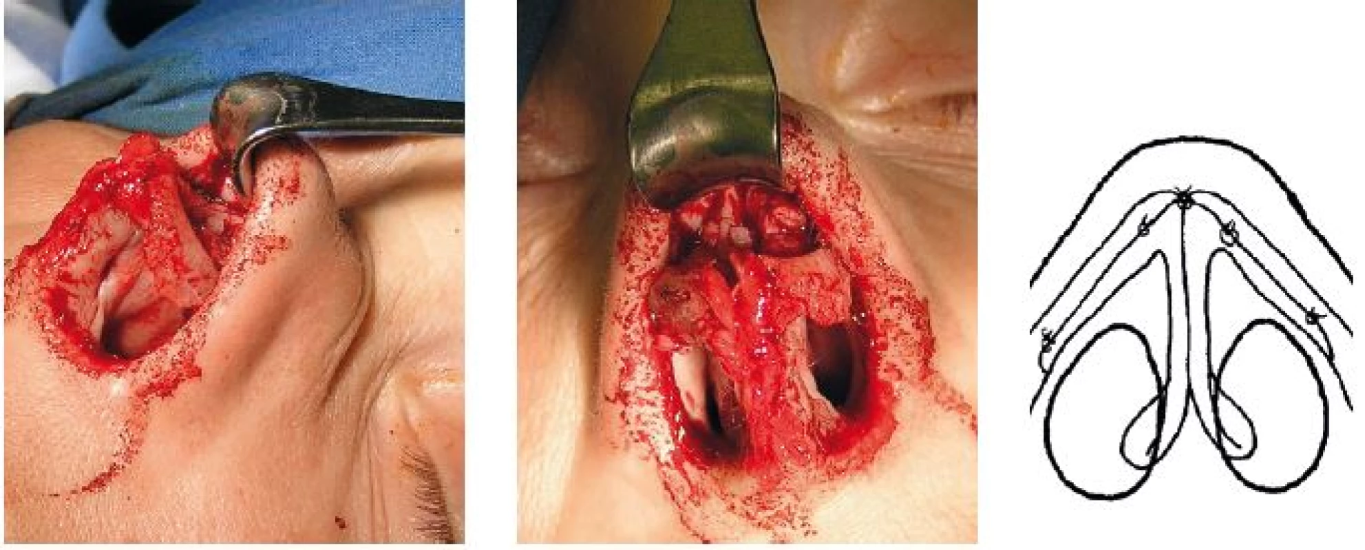 Vľavo: pohľad z boku chrupkové štepy sutúrované k zvyšku alárnej chrupky v žiadanej polohe. V strede: ďalší chrupkový štep vložený ako výplňový materiál na dorzum nosa do podkožného tunela. Na konci rekonštrukcie nasleduje sutúra dómov v novej pozícii. Vpravo: schéma augmentácie v rozsahu celého laterálneho ramena.