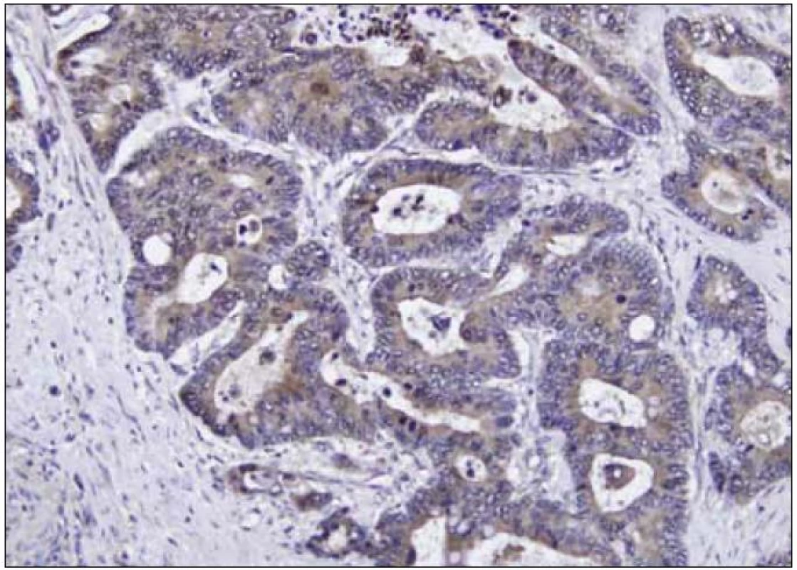 Imunohistochemické barvení tkáně kolorektálního karcinomu – nádorové buňky jsou pozitivní na PAI 2 (zvětšeno 200krát).